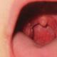 Стрептококк группы а. Стрептококк. Обнаружен стрептококк в носу, горле, зеве, на коже, что делать? Стрептококк у грудных детей. Как выявить лечить инфекцию