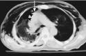 pneumothorax ที่เกิดขึ้นเอง: สาเหตุ