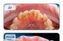 Плюсы и минусы чистки зубов методом Air Flow