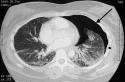 Pneumothorax : causes, symptômes et soins d