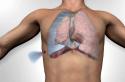 Vad är faran med pneumothorax - ansamling av luft i pleurahålan?
