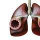 Paano gamutin ang obstructive bronchitis at ano ito?