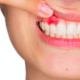 Почему появляется свищ зуба после удаление зуба