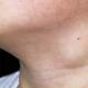 Inflamación de los ganglios linfáticos del cuello - tratamiento en el hogar