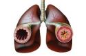 Paano gamutin ang obstructive bronchitis at ano ito?