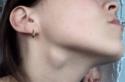 Uzroci povećanja limfnih čvorova na vratu: liječenje