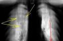 Oscurecimiento en los pulmones en una imagen fluorográfica.