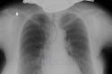 Oscurecimiento de los pulmones en fluorografía.