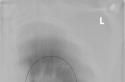 Manchas oscuras en los pulmones con fluorografía.