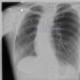 Šta znači zamračenje u plućima na rendgenskom snimku?