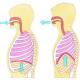 Symtom och behandling av pneumothorax i lungan